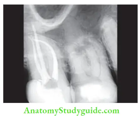 Obturation Of Root Canal System Radiograph showing radiopaque gutta-percha.