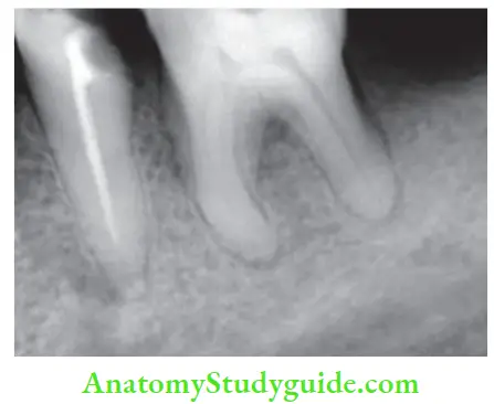 Obturation Of Root Canal System Radiograph showing underfiled canal of mandibular second premolar.