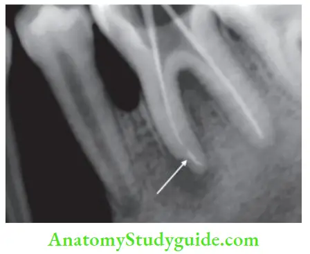 Obturation Of Root Canal System S-shaped appearance of cone in mesial canal shows that cone is too small for the canal, replace it with bigger cone.