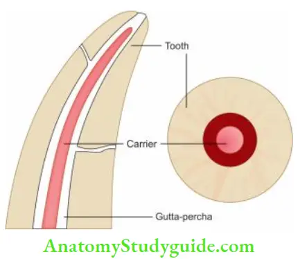 Obturation Of Root Canal System The carrier is not primary cone for obturation. It acts as a carrier for carrying thermoplasticized gutta-percha.