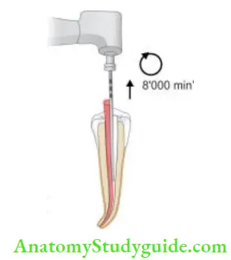 Obturation Of Root Canal System Thermomechanical compaction of gutta-percha, McSpadden compaction.