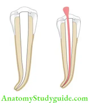 Obturation Of Root Canal System Thoroughly clean and shape the canal; adjust the cone to working length