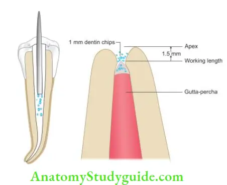 Obturation Of Root Canal System chips being compacted with blunt end of instrument paper point; compaction of dentin chips in apical 2 mm