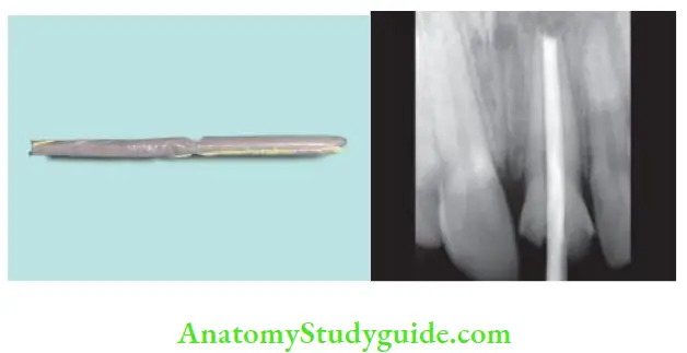 Obturation Of Root Canal System custom-made gutta-percha cone; Radiograph taken with master cone