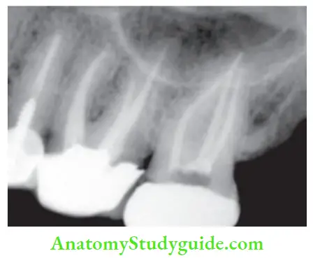 Obturation Of Root Canal System obturation in maxillary premolar and molars.