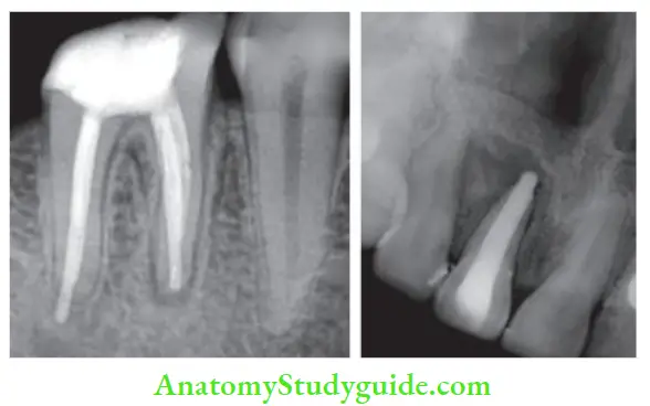 Obturation Of Root Canal System overfiled- Distal canal of mandibular molar; Maxillary central incisor.