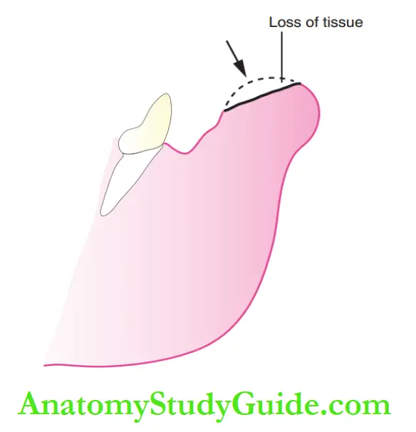 Oral Soft Tissue Injuries Avulsion Loss of tissue.