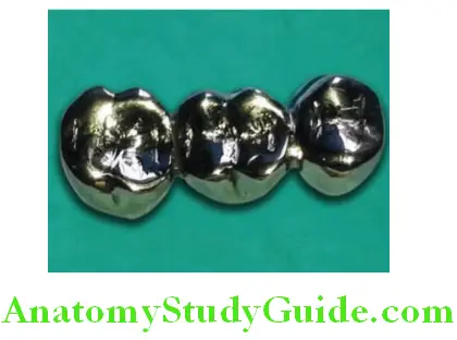 Overview of Prosthodontics all metal fixed partial denture