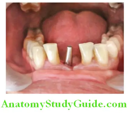 Overview of Prosthodontics implant placed in mandibular anterior region