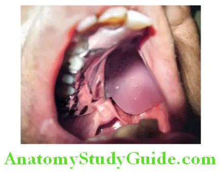 Overview of Prosthodontics obturatoe in oral cavity