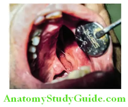 Overview of Prosthodontics palatal defect