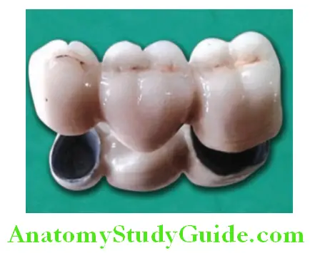 Overview of Prosthodontics porcelain fused to metal fixed partial denture