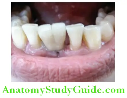 Overview of Prosthodontics prosthesis retained by implant