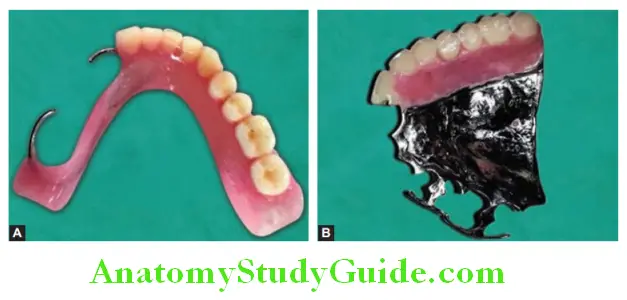 Overview of Prosthodontics removable partial denture