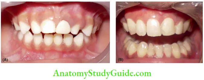Paediatric Periodontics An Overview Gingival Margin In Primary And Permanent Dentition