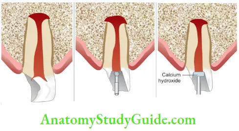 Parital Pulpotomy Is Indicated With Incomplete Root Information;Preparation Of Cavity 1-2 mm Deep Into Pulp;Placement Of Calcium Hydroxide Over Pulp