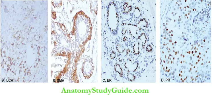 Pathologic Diagnosis Of Tumours Common IHC Staining At different Sites In The Tumour Cells