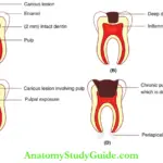 Peadiatric Endodontics An Overview Extent Of Carious Involvement