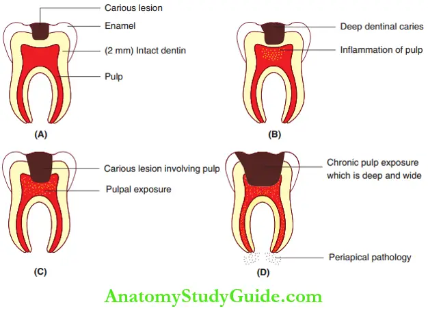 Peadiatric Endodontics An Overview Extent Of Carious Involvement