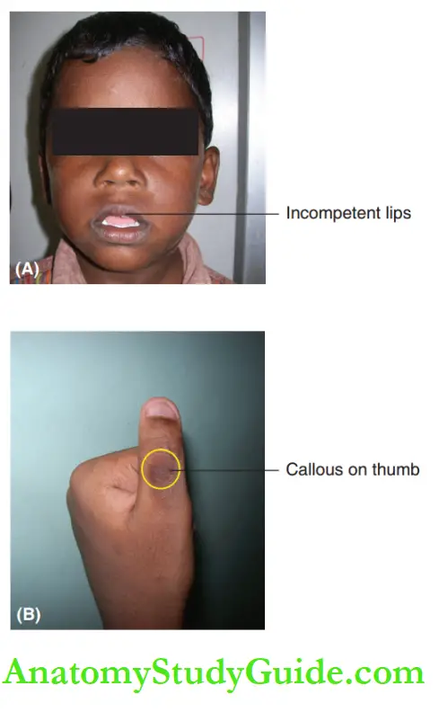 Pernicious Oral Habits Notes Extraoral features of thumb or digit sucking