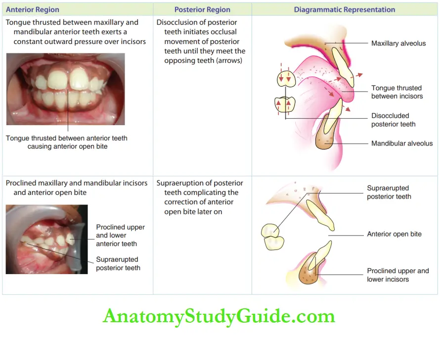 Pernicious Oral Habits Notes Features of Tongue Thrusting Habit