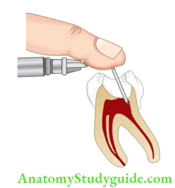 Pharmacology In Endodontics Notes For intrapulpal injection, needle is bent to gain access into the canal.