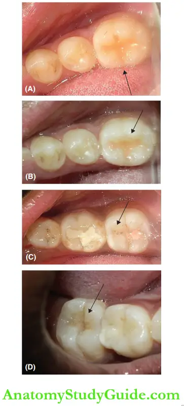 Pit And Fissure Sealants Clinical Examination Of The Various Stages Of Glass Ionomer Based Pit And Fissure Sealants