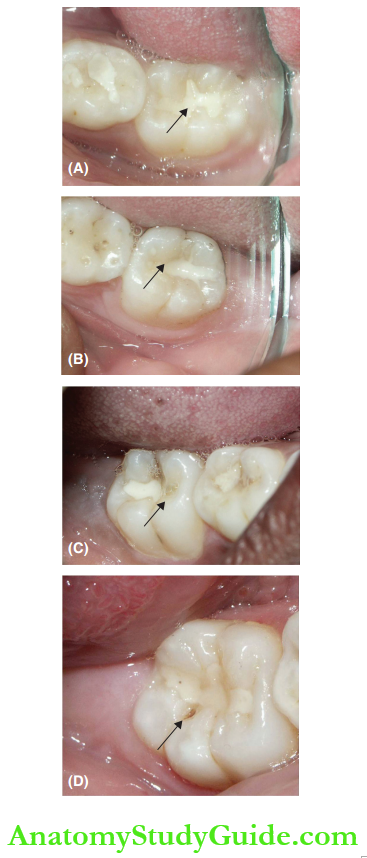 Pit And Fissure Sealants Clinical Examination Revealed Various Stages Of The Resin Pit And Fissure Sealants