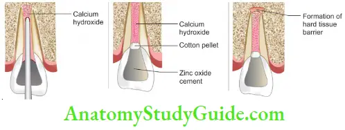 Placement Of Calcium Hydroxide In The Canal;Restoration Of The Tooth With Zinc Oxide Cement; Formation Of Hard Tissue Barrier At Apex