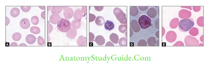 Plasmodium Species And Babesia Thin blood smear showing different forms of Plasmodium