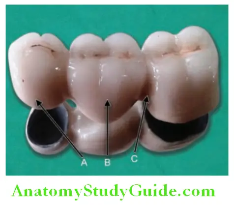 Pontic Retainers And Connectors parts of fixed partial denture