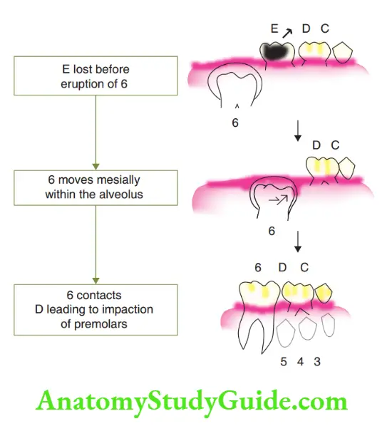 Preventive Orthodontics notes Loss Of Second Primary Molars