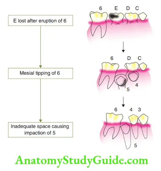 Preventive Orthodontics notes Loss of the second primary molar after the eruption of the eruption of the perment molar