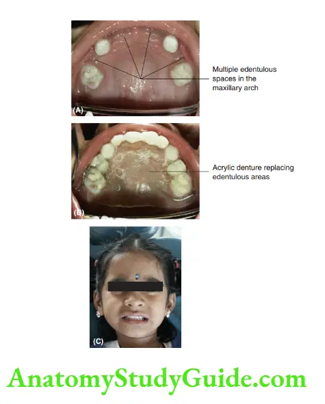 Preventive Orthodontics notes Maxillary arch with multiple teeth lost due to caries