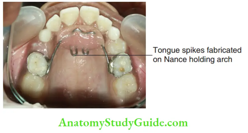 Preventive Orthodontics notes Modifiations of the Nance holding arch Habit