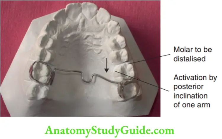Preventive Orthodontics notes Modifiations of the transpalatal arch Molar Distalisation appaliance