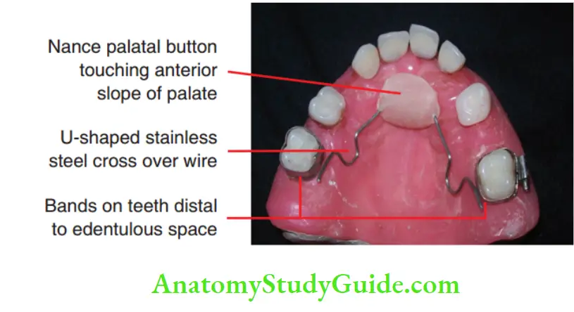 Preventive Orthodontics notes Nance holding arch