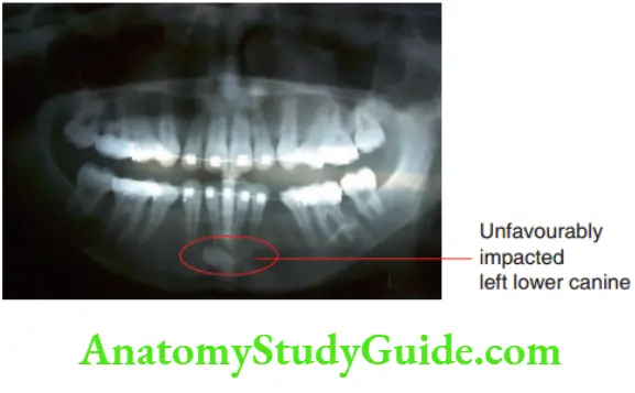 Preventive Orthodontics notes OPG showing iatrogenic malocclusion created by not verifying the canine poasition before the serial extraction procedure