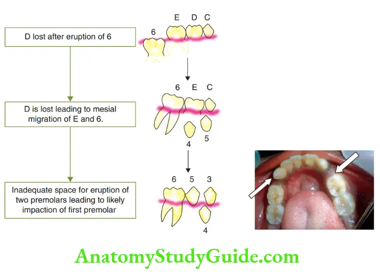 Preventive Orthodontics notes Primary fist molar lost after the eruption of the permanent fist molar, leading to impaction of the fist premolar.