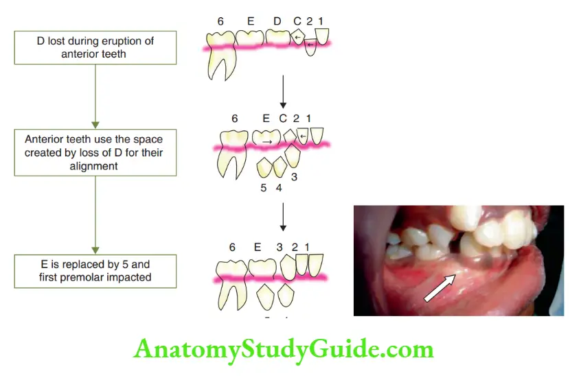 Preventive Orthodontics notes Primary fist molar lost during the eruption of anterior teeth, leading to impaction of premolars