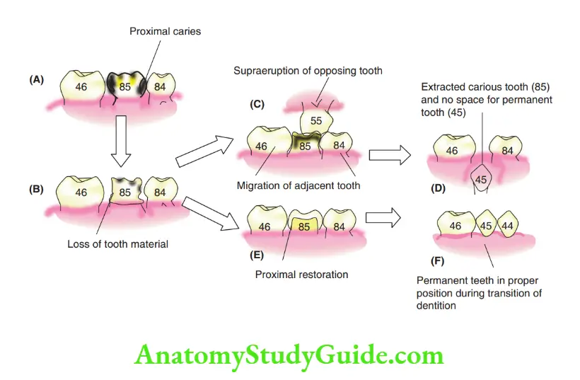 Preventive Orthodontics notes Sequelae of proximal caries in the second primary molar