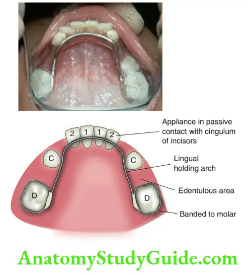 Preventive Orthodontics notesLingual holding arch