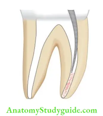 Procedural Accidents Accumulation of dentinal debris in apical third because of loss of working length.