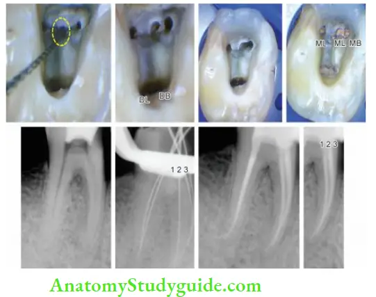 Procedural Accidents Endodontic treatment of mandibular molar with fie canals, i.e. mesiobuccal, middle mesial, mesiolingual, distobuccal and distolingual.