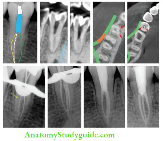 Procedural Accidents Endodontic treatment of mandibular premolar with split canals. Presence of three canals confimed with CBCT.