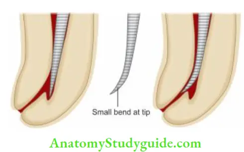 Procedural Accidents Formation of ledge by use of stif instrument in curved canal;Correction of ledge; ledge is bypassed by making a small bend at tip of instrument.