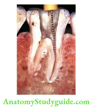 Procedural Accidents Gain straight line access to canal orifies by removing all caries, restoration and unsupported tooth structure