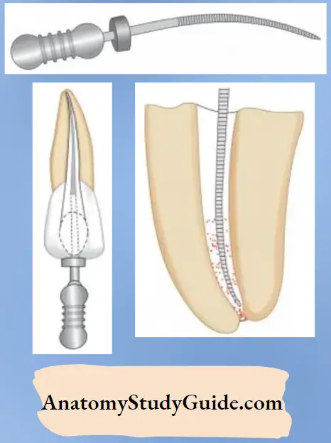 Procedural Accidents Inadequately Cleaned And Shaped Root Canal System