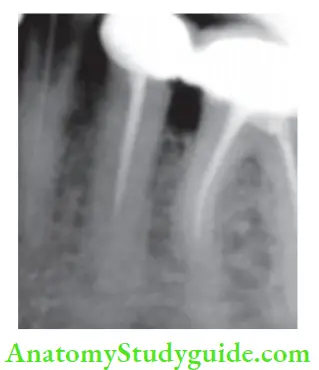 Procedural Accidents Inadequately shaped canal prevents three-dimensional obturation of root canals.