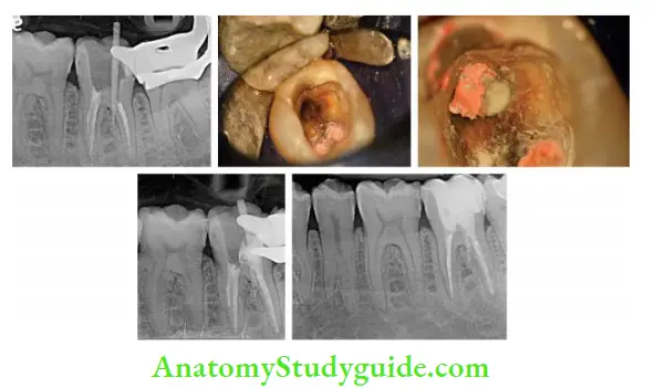 Procedural Accidents Management of perforation repair of mandibular second molar